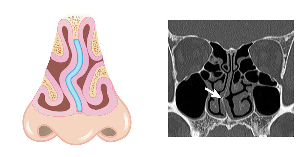 鼻中隔彎曲常合併肥厚性鼻炎，造成主鼻道空間狹小，影響氣流因而有鼻塞的現象產生。