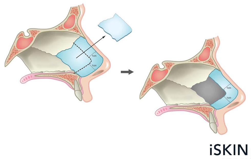 鼻中隔黏膜下切除術(Submucosal resection)，是常見的鼻中隔矯正手術。在手術中要保留L型的鼻中隔軟骨( L strut)，意思是在鼻中隔上部及尾端部分，留下厚度約1公分左右的樑柱，才有足以支持結構的力量，以防止塌鼻發生。