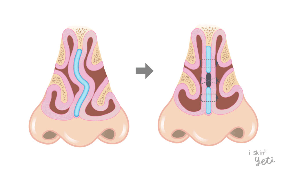 鼻中隔黏膜下切除術(Submucosal resection)：