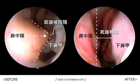 鼻中隔彎曲手術-患者術前鼻中隔彎曲如同骨刺般，幾乎與下鼻甲黏在一起，造成氣流阻塞，經矯正鼻中隔後氣道變寬，呼吸也順暢了。