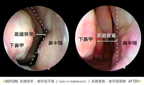 鼻中隔彎曲手術-患者的術前鼻黏膜十分蒼白水腫，且嚴重的鼻中隔彎曲還有下鼻甲肥大，造成鼻塞與打呼嚴重，經過矯正鼻中隔彎曲與黏膜下鼻甲部分切除手術後，氣道變寬，鼻黏膜敏感蒼白也改善了。