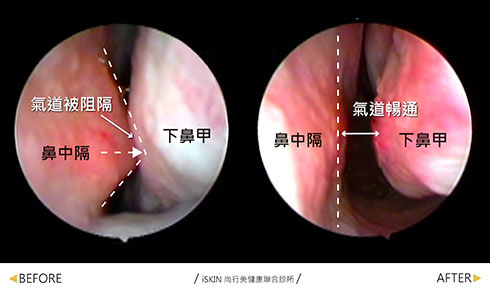鼻中隔彎曲手術-嚴重鼻中隔彎曲與下鼻甲緊貼因此導致嚴重鼻塞難以呼吸，矯正後已明顯改善鼻閥的通暢度，原本的鼻過敏導致的鼻黏膜蒼白也變成正常的黏膜。