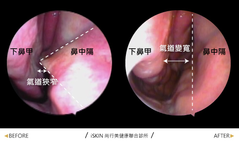 A先生由於長期鼻塞，連帶影響本身及另一半的睡眠品質，看過很多診所也去大醫院檢查，醫院說猶如嚴重骨刺般的鼻中隔彎曲，無法完全矯正，後來求助iSKIN鼻中心，經由免住院微創鼻中隔彎曲矯正手術後，氣道明顯由狹窄變為寬敞，感受許久未曾有過的暢快呼吸，和另一半的感情也越來越好了。