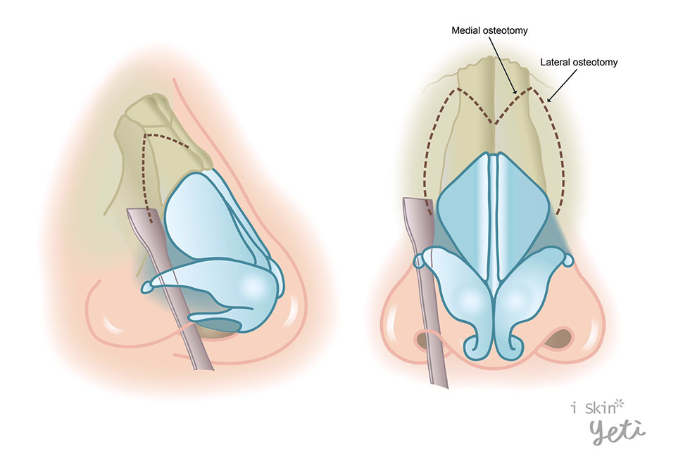 截骨術(Osteotomies)示意圖