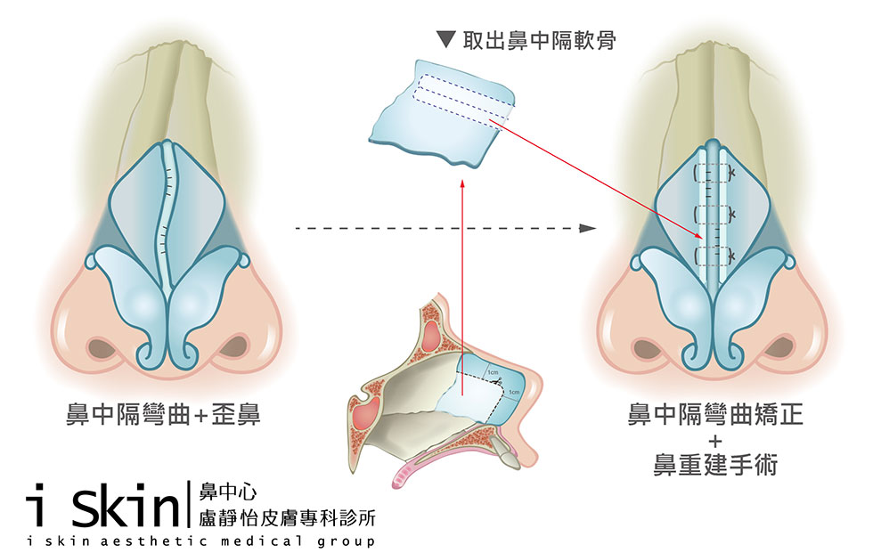 中段三分之一歪鼻治療在L型鼻中隔軟骨上製造小切痕，利用取出的鼻中隔軟骨(Harvested septal cartilage graft)當作重建的材料(Spreader graft) 與切痕縫合(Scoring & suture)以利塑形並加以固定。