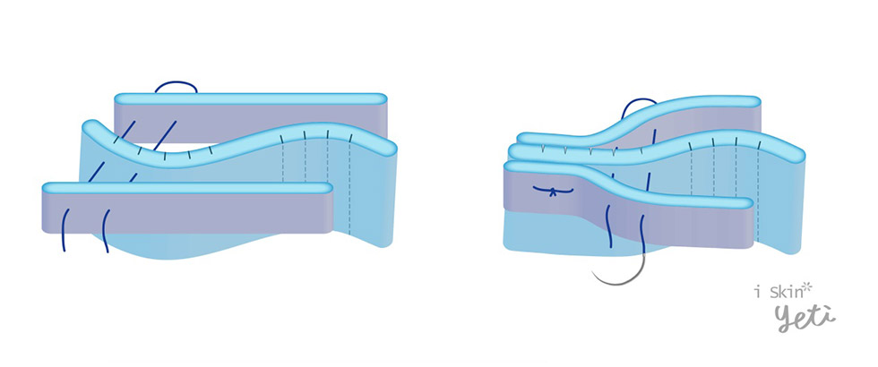 中段三分之一歪鼻治療，鼻中隔支架(Spreader graft)與切痕縫合( Scoring & suture)示意圖。