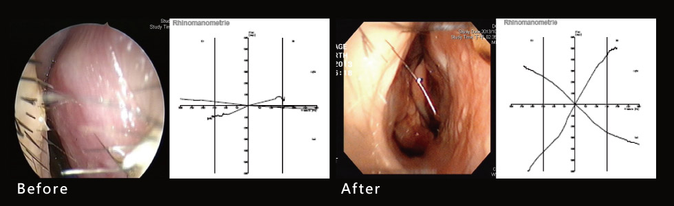 透過手術前後鼻阻力圖對照，術前左右兩側鼻阻力線都接近水平線，表示呼吸阻力極大，術後鼻阻力線恢復正常曲線，接近兩邊對稱，表示呼吸恢復暢通，傷口也恢復良好。</p>
                      <p>首先，經過我們團隊進行完整的鼻中隔成形手術後。接著，在鼻子上端實施兩邊的鼻截骨術(Osteotomy)與鼻部中段下段的鼻重建手術( Spreader graft)，最後，再利用軟骨切痕縫合術  (Cartilage scoring and suture)，同時矯正其鼻內部功能及外部美觀的問題。