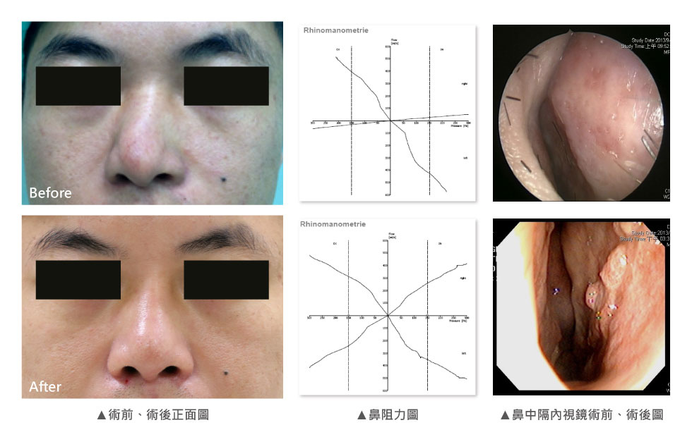 P先生，對自己的外型身材都很有自信，唯獨鼻型讓他十分不滿意，同時也有長期鼻塞問題。求職後，同事也三不五時提醒他「歪鼻」的事實。最後，他下定決心在年前整頓「鼻子」過好年，從外觀來看，P先生從上端鼻骨往右歪斜，下端往左偏斜，呈現C型歪鼻。同時合併兩邊鼻孔不對稱，鼻頭右偏，從內視鏡圖也可看出右側鼻中膈嚴重彎曲，右側鼻阻力圖幾乎呈水平狀，代表右側鼻腔氣流極度不順。<br />
我們團隊處理方式以進行右上側截骨術，並利用本身的鼻中隔軟骨，作為中段與下段鼻小柱的重建材料(Spreader graft& columellar strut)。而尾端鼻中隔彎曲的部分也利用鼻中隔旋轉繞道術(Swinging door maneuver)及軟骨切痕縫合術(Scoring&Sutures)完成。另外，P先生希望順便加入人工卡麥拉鼻模，讓鼻子挺上加挺。術後一個月，可明顯看見眉間、鼻頭、人中三點成一直線，鼻子又挺又直。
