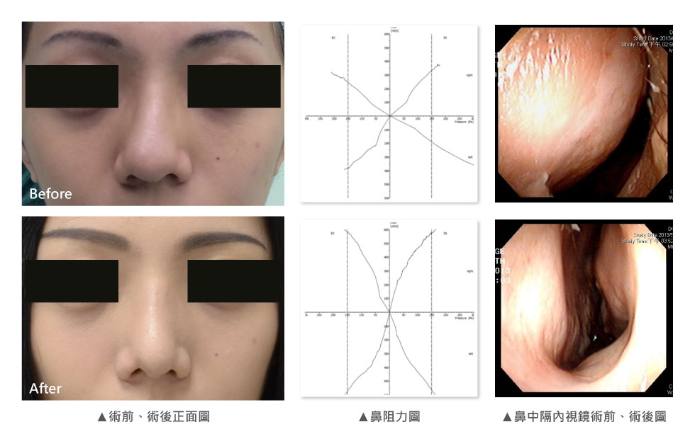 每個女生都愛美，D小姐也不例外。她特別羨慕韓國女星挺直小巧的鼻型，因為她的鼻頭偏大、又有明顯的歪鼻，尤其鼻背又有輕微駝峰，每次照鏡子看到鼻子，總是特別自卑。為了重建D小姐的自信心，經由我們團隊詳細的檢查後，發現D小姐鼻中隔軟骨呈現S型，我們同時做了左右兩側的截骨術，並利用特殊的磨骨器將輕微突出的鼻骨磨平，合併所鼻手術讓鼻頭變小。再利用本身的鼻中隔軟骨，作為中段與下段鼻小柱的重建材料(Spreader graft& columellar strut)，術後效果讓D小姐大為驚豔，除了歪鼻變正之外，看起來更翹，鼻頭小巧迷人，最棒的是，全程手術都以D小姐本身的鼻中隔軟骨為材料，並未使用人工材料。