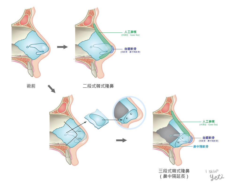 上圖為韓式隆鼻圖解。從沒做過鼻整形手術的鼻部，依據個人需求調整程度不同，透過自體軟骨與人工鼻模的搭配，或是再加上鼻中隔延長，成就完美自然的鼻形。