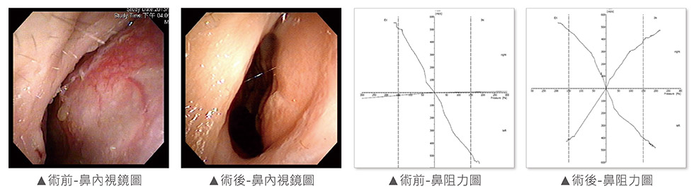 經由內視鏡檢查，發現右側尾端鼻中隔彎曲，幾乎貼近側壁；術前右側鼻阻力圖幾乎呈水平線，代表沒有氣流通過。術中發現鼻中隔扭曲變形、左上側軟骨凹陷萎縮；我們團隊進行鼻部結構拆解及鼻中隔成型手術，利用取下來的鼻中隔軟骨進行重建(Batten Graft)。術後恢復良好，鼻中隔置中，氣流通暢。