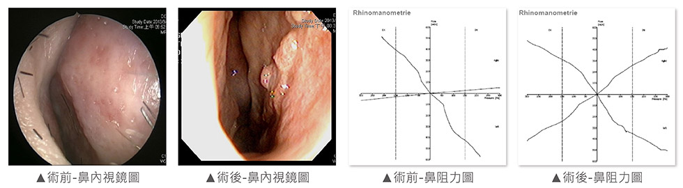 從內視鏡圖也可看出右側鼻中隔嚴重彎曲，右側鼻阻力圖幾乎呈水平狀，代表右側鼻腔氣流極度不順。尾端鼻中隔彎曲的部分，也利用鼻中隔旋轉繞道術(Swinging door maneuver)及軟骨切痕縫合術(Scoring&Sutures)完成。