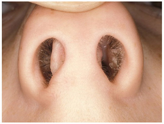 透過仰視圖及內視鏡圖可明顯看出，除了鼻孔不對稱外，又合併尾端鼻中隔彎曲，造成患者呼吸不順，鼻塞嚴重。(左圖取自網路)