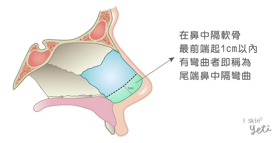 尾端鼻中隔彎曲圖示，綠色區塊為尾端鼻中隔軟骨，若此處有彎曲情況，則稱為尾端鼻中隔彎曲。