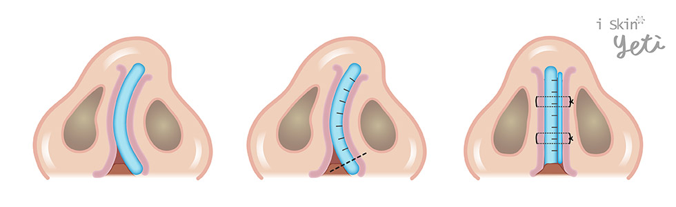 鼻中隔軟骨切痕縫合術示意圖。