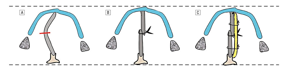 軟骨切縫重建術 (Cutting & Suture technique)示意圖，此由韓國鼻整型大師Dr. Jang所提出。