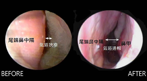 從鼻內視鏡檢查中，可明顯看出左側尾端鼻中隔彎曲，導致氣道狹窄、呼吸不順，醫療團隊依據患者鼻結構的狀況，採用    內開微創式尾端鼻中隔彎曲重建手術 ，術後氣道變寬，呼吸順暢，解決患者多年來的鼻塞困擾，看到患者回診滿意的笑容，就是iSKIN醫療團隊最大的動力。