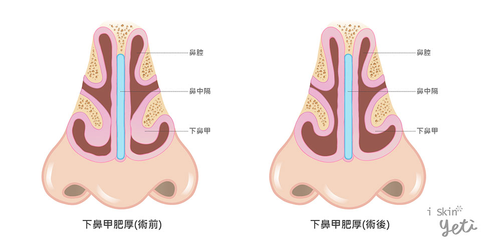 上圖為鼻部透視圖，術前可發現下鼻甲組織增厚，幾乎與鼻中隔相黏，以致呼吸不通暢；經過治療後，下鼻甲與鼻中隔距離分隔，鼻腔暢通不阻塞