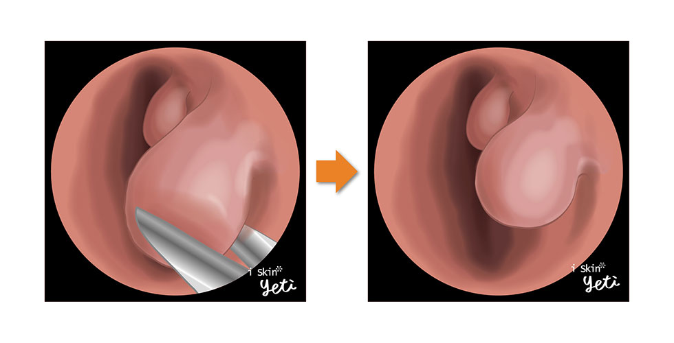 經由傳統下鼻甲部分切除術(Submucosal turbinectomy)修整後(圖左至右)，下鼻甲體積縮減，讓呼吸更加自在暢通。