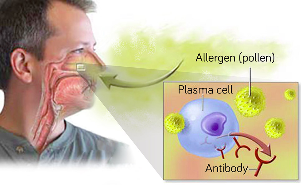 過敏原如花粉等，進入體產生漿細胞抗體，造成過敏性鼻炎