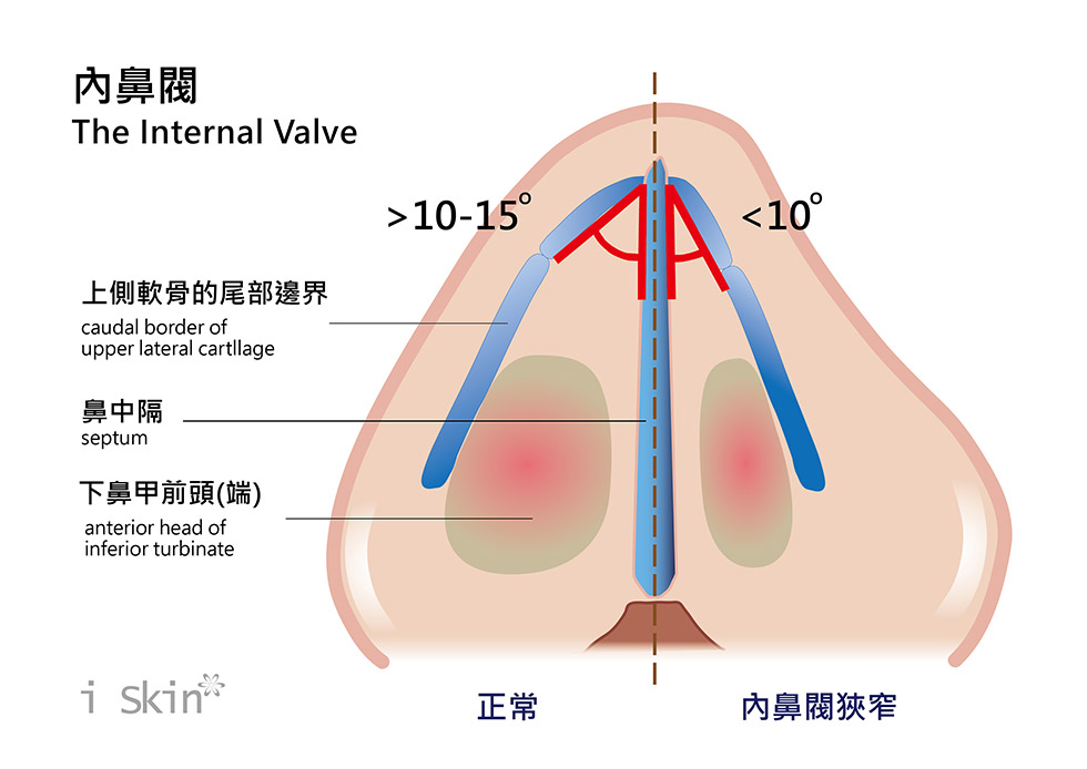 內鼻閥的上側軟骨與鼻中隔的夾角，小於10~15度角，就可視為內鼻閥狹窄。