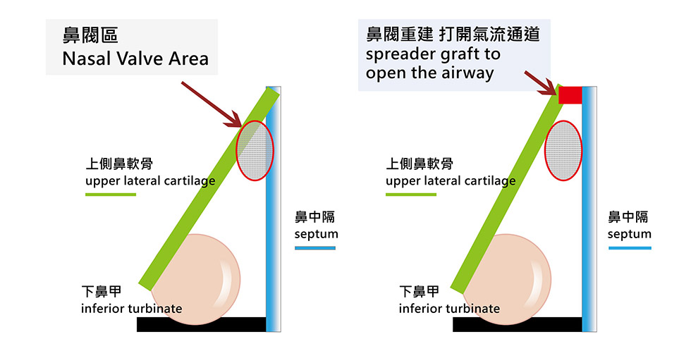 狹窄的內鼻閥經過楔狀軟骨(Spreader graft)撐開，讓上側軟骨(Upper lateral cartilage)與鼻中隔的夾角變大超過15度角，氣流更暢通