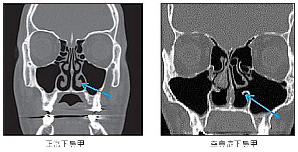 圖為正常人的鼻腔，與空鼻症鼻腔電腦斷層圖，圖中(如箭頭所示)可看到正常鼻腔有三對鼻甲，而空鼻症的鼻腔下鼻甲幾乎所剩無幾。