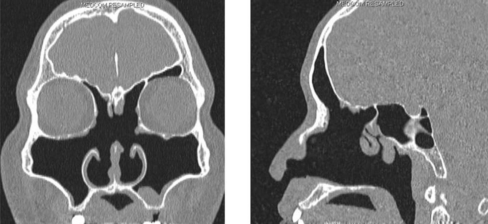 一個40歲非過敏性鼻炎男病人，接受四次的鼻竇鼻炎手術，CT顯示明顯的缺乏下鼻甲、中鼻甲，而上鼻甲也只剩下一點點。