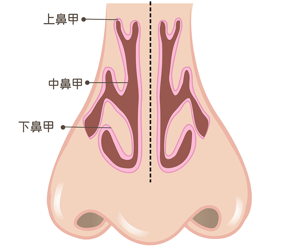 經由傳統下鼻甲部分切除術(Submucosal turbinectomy)修整後(圖左至右)，下鼻甲體積縮減，讓呼吸更加自在暢通。