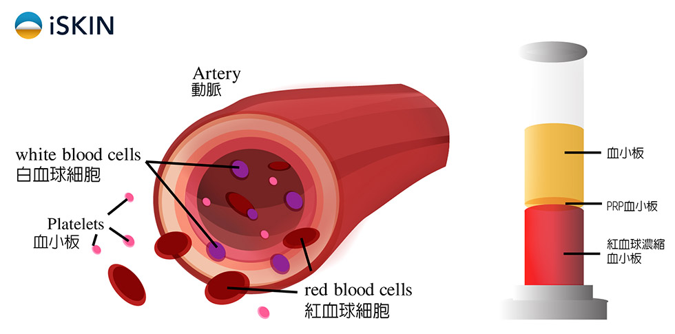 PRP (platelet-rich plasma)注射