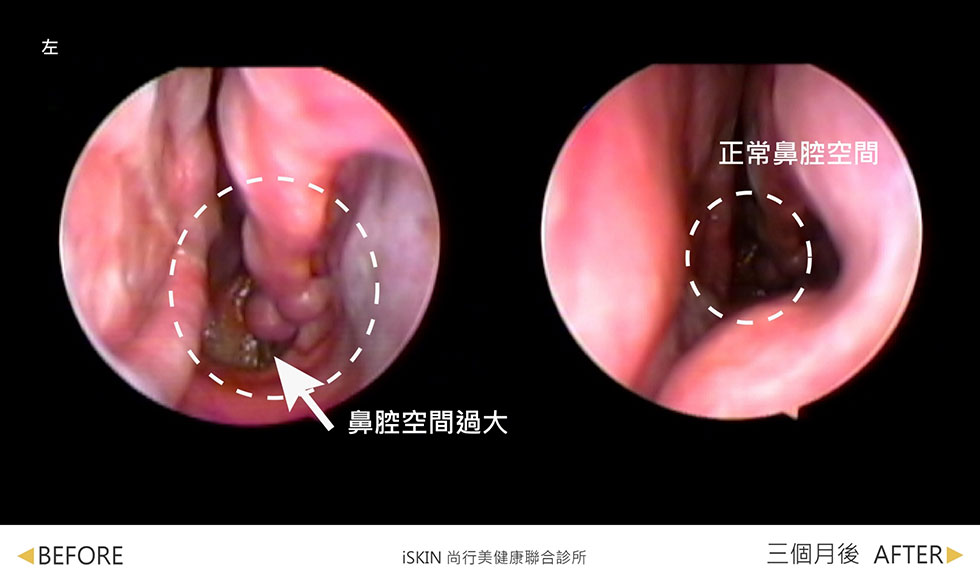 標示處為下鼻甲，在經過兩次傳統手術切除後，下鼻甲所剩無幾（如箭頭標示處），導致Henson鼻腔空間過大。