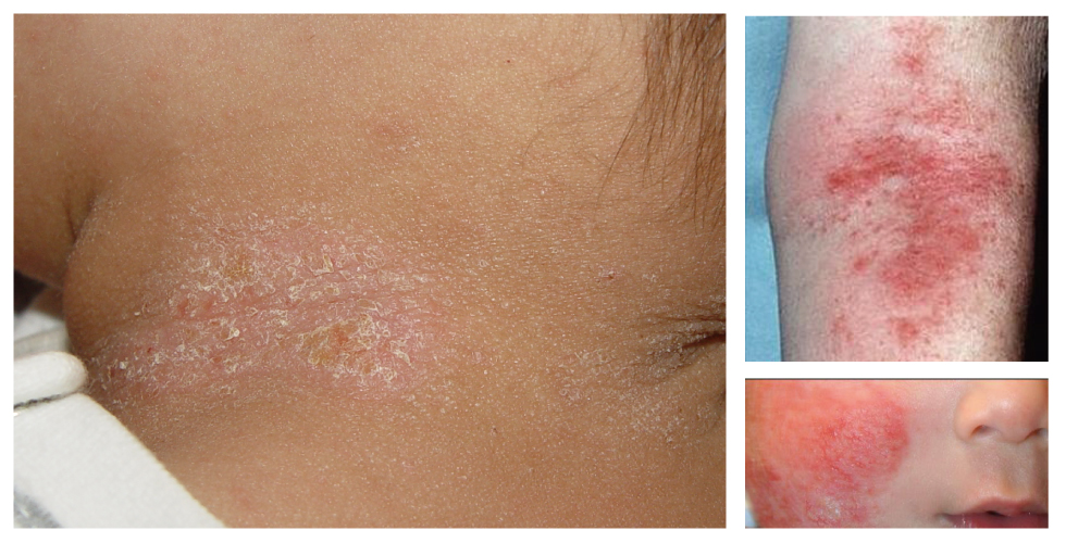 異位性皮膚炎，多發生於孩童。