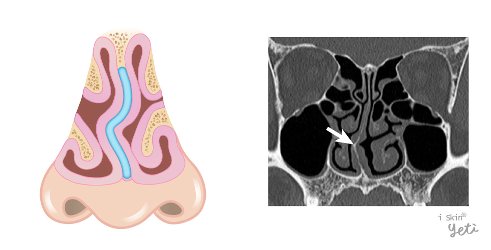 鼻中隔彎曲示意圖，如箭頭所示。
