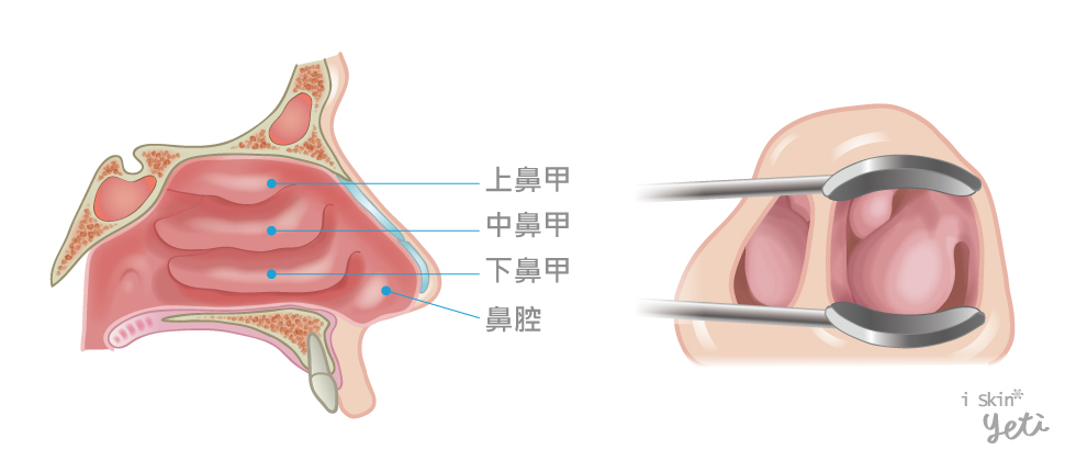 左圖為正常鼻腔構造，有三對鼻肉組織；右圖是下鼻甲肥大時，會阻塞鼻腔的呼吸管道，造成鼻塞困擾。