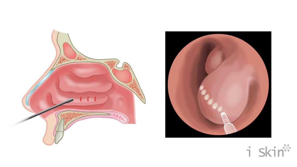 雷射下鼻甲微創術示意圖