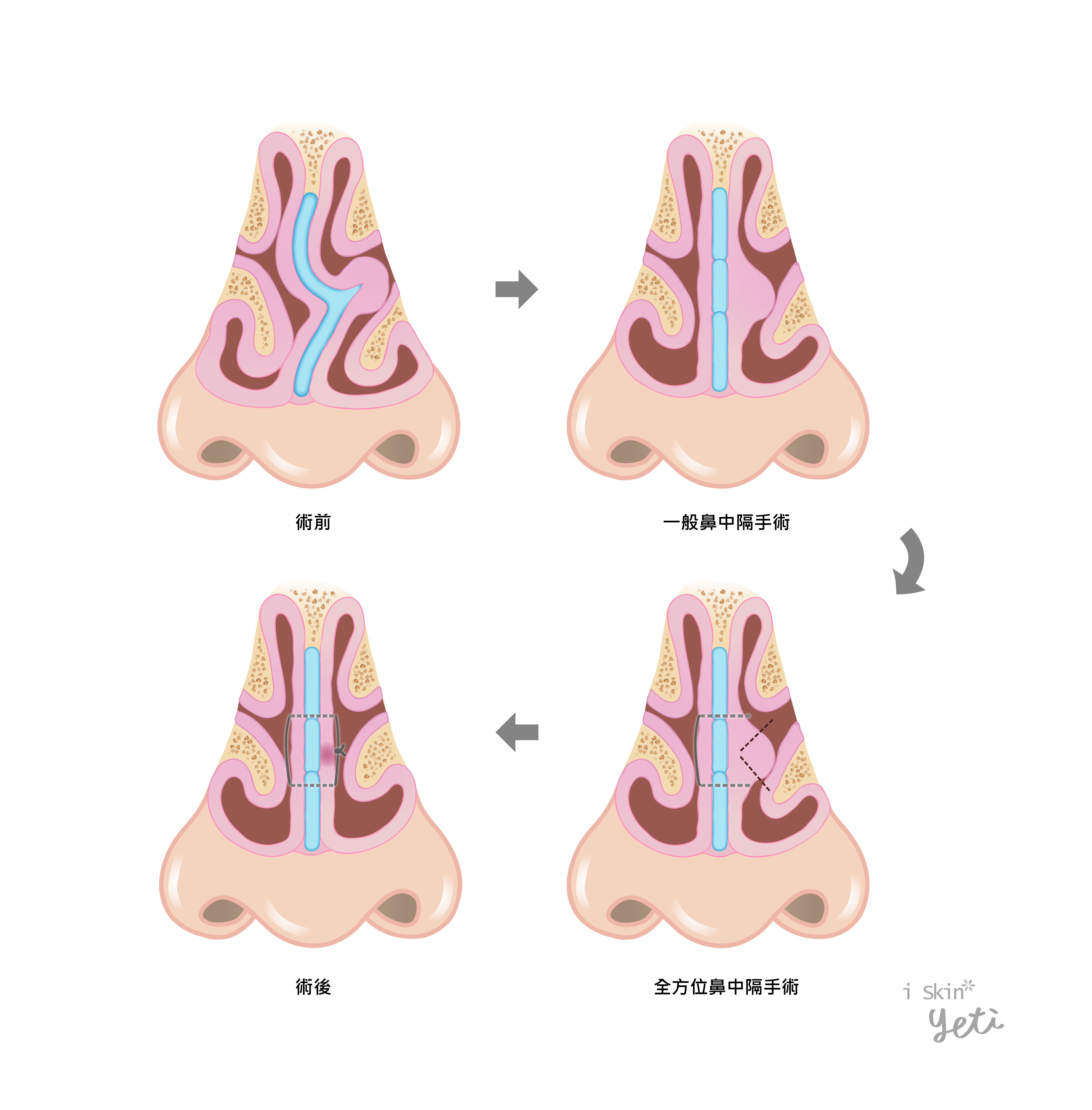 iSkin鼻中隔全方位矯正術除了進行骨架結構調整與縫合外，也會對於肥厚的黏膜作有效的切割塑形，比常規的鼻中隔黏膜下切除術有更好的手術效果。