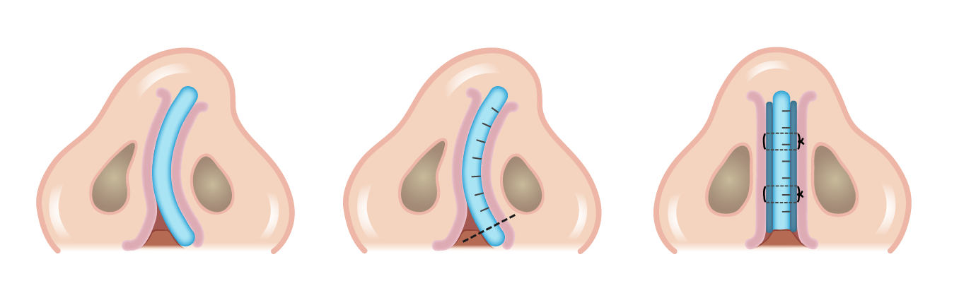 鼻中隔軟骨切痕縫合術示意圖。