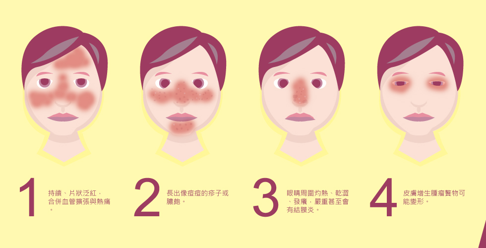 盧靜怡醫師評價 難纏的酒糟類型
