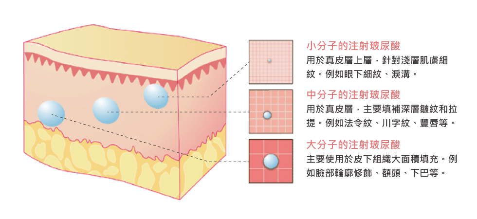 玻尿酸分為大分子、中分子與小分子。要填充面積較大的部位，像是雙頰與太陽穴、蘋果肌，需要黏稠性較高的大分子玻尿酸；若像是淚溝及細紋，則需要小分子玻尿酸，以免結成小團塊。