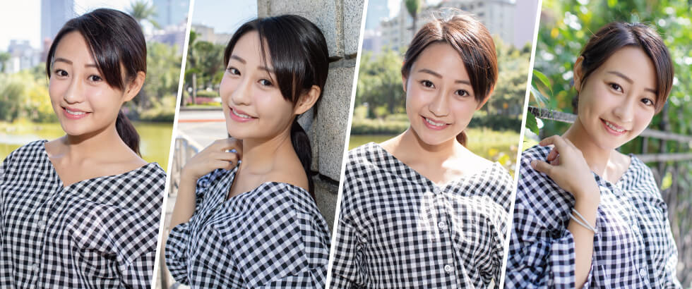 皮秒雷射去除肝斑案例分享