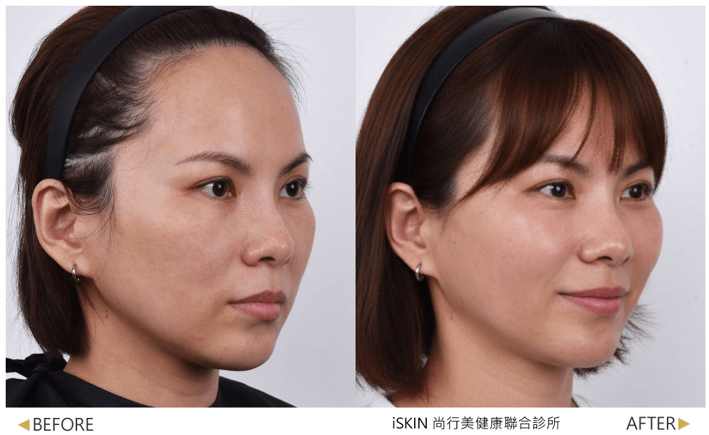 加強輪廓的緊緻度是音波拉提效果之一