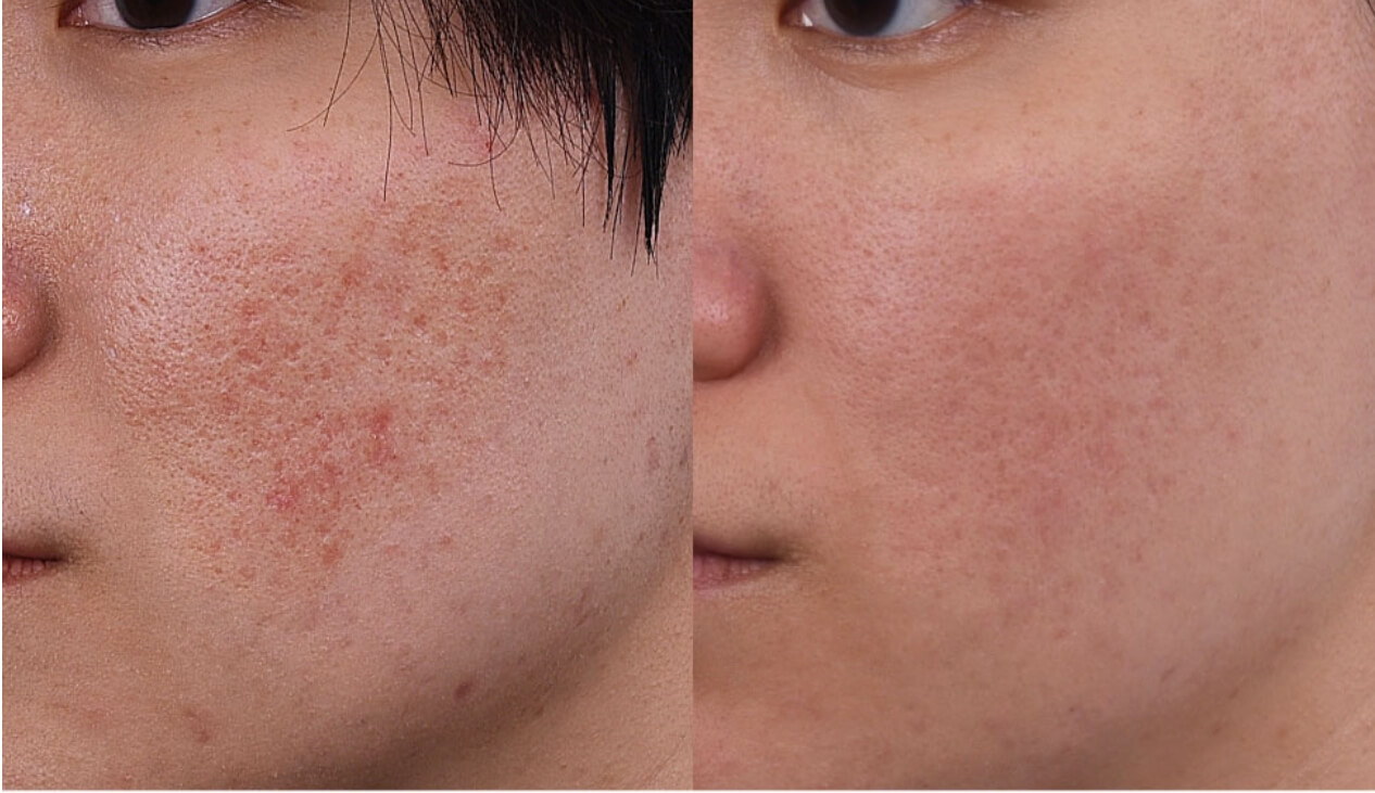 Ivory 的 UP 雷射案例分享