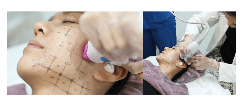 電波音波一起打可以同步得到緊緻外層、拉提深層的複合效果