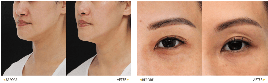 電波拉提效果包含緊緻臉部輪廓、改善法令紋、撫平眼周肌膚等