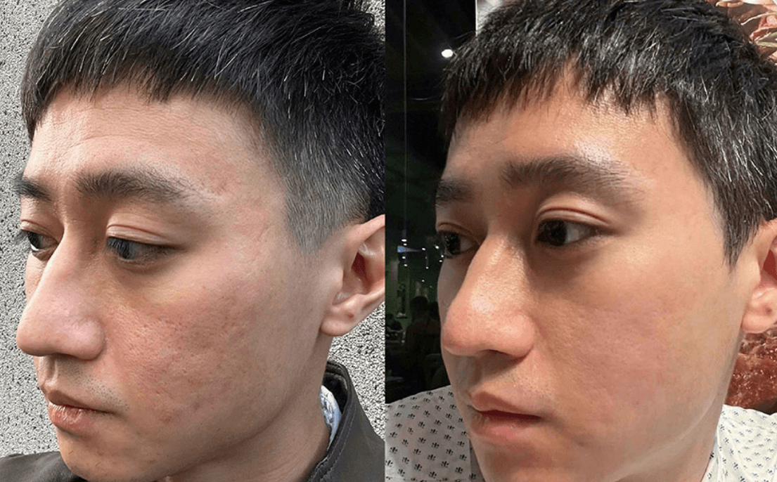 Alex UP 雷射案例分享