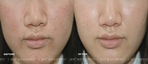 做完淨膚雷射之後，皮膚明顯變得更加透亮細緻