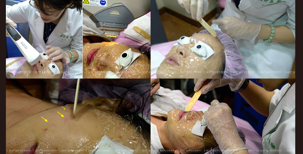 （左上圖 塗上脈衝光凝膠，脈衝光治療中）（左下圖，盧醫師說：臉頰上就是微血管擴張的效果） （右上圖，脈衝光 如同鹹蛋超人 眼睛防護）（右下圖，術後敷上面膜鎮靜保溼）