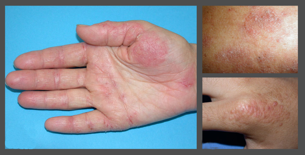 手部濕疹-慢性苔癬化。