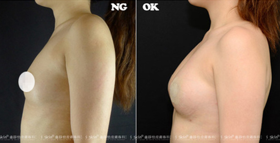 經過自體脂肪隆乳後，呈現性感渾圓的胸型