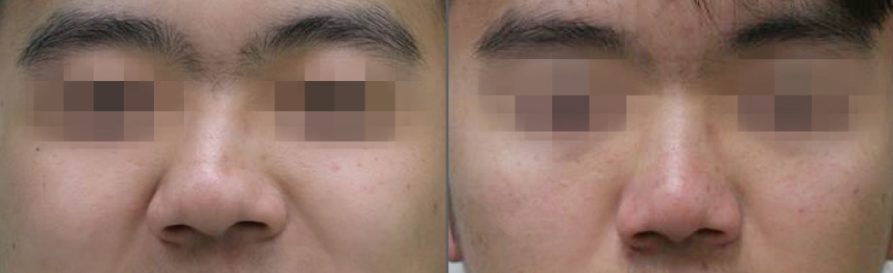 (左)術前，明顯鼻形歪斜。(右)術後一個月，歪斜的鼻子置中，兩邊鼻子對稱自然，同時塞鼻也明顯改善。手術造成的腫脹、不適幾乎消失，恢復良好。